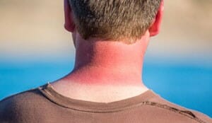 sunburn norway